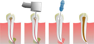 root-canal-treatment-astoria